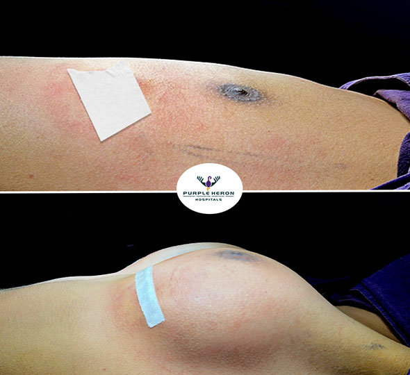 Plastic Surgery Patient of Dr. Lamoria