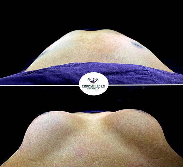 Plastic Surgery Patient of Dr. Lamoria