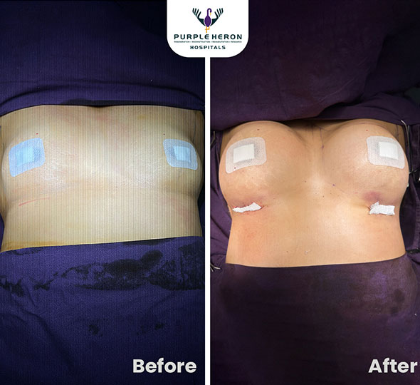 Plastic Surgery Patient of Dr. Lamoria