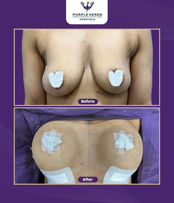 BREAST SURGERY Consultation