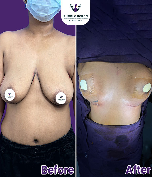 BREAST SURGERY