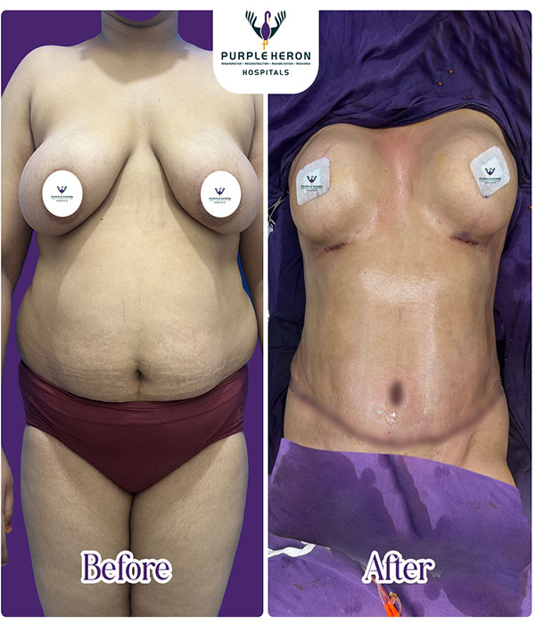 BREAST SURGERY