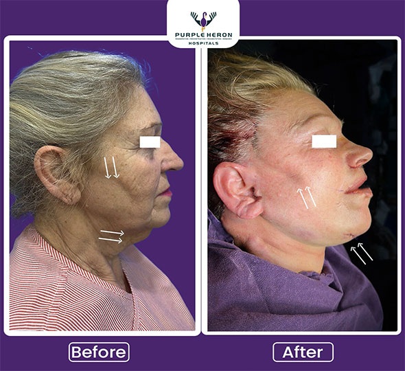 Plastic Surgery Patient of Dr. Lamoria