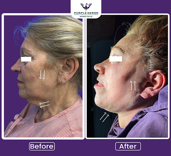 Plastic Surgery Patient of Dr. Lamoria