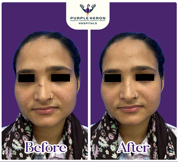 Plastic Surgery Patient of Dr. Lamoria