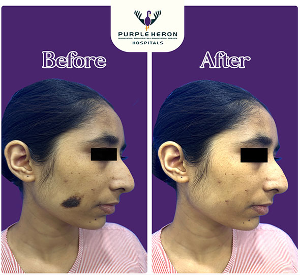 Plastic Surgery Patient of Dr. Lamoria