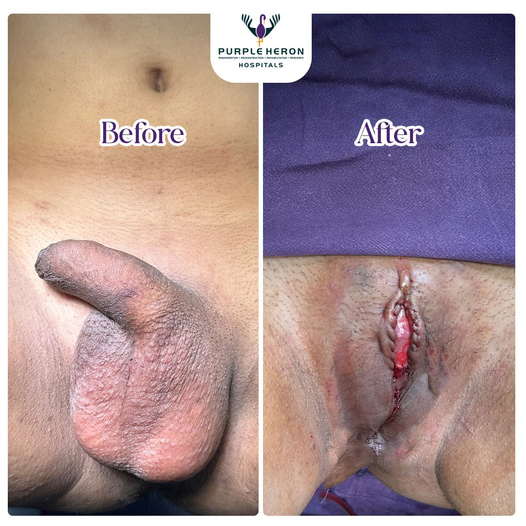 Plastic Surgery Patient of Dr. Lamoria