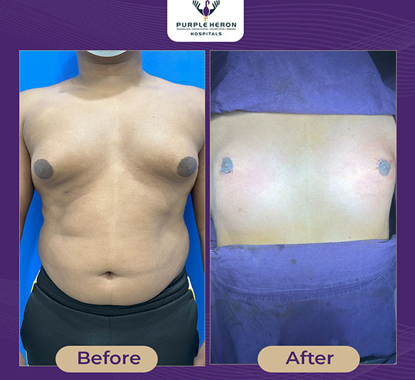 Plastic Surgery Patient of Dr. Lamoria