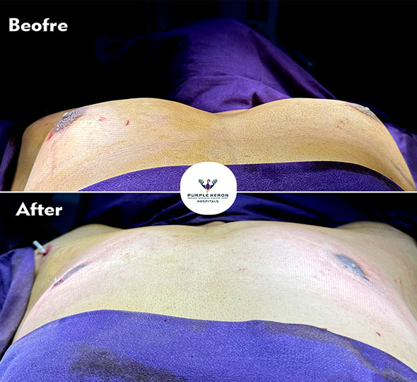 Plastic Surgery Patient of Dr. Lamoria