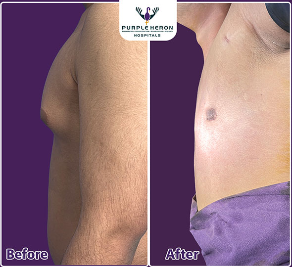 Plastic Surgery Patient of Dr. Lamoria