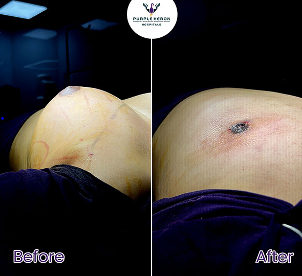 Plastic Surgery Patient of Dr. Lamoria