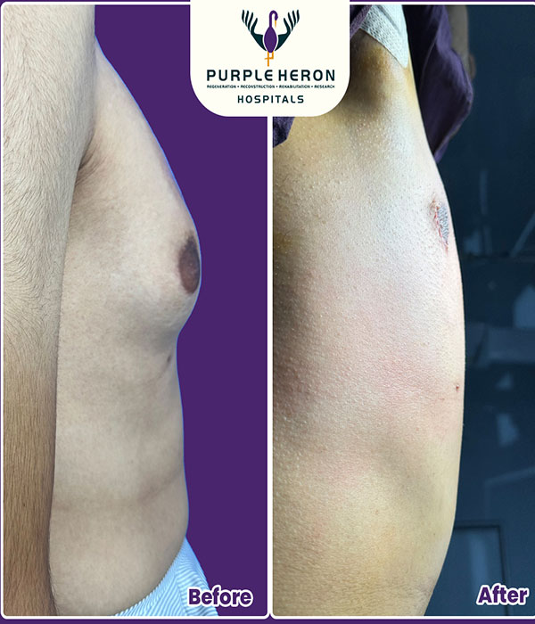 GynecomastiaSurgery Expertise