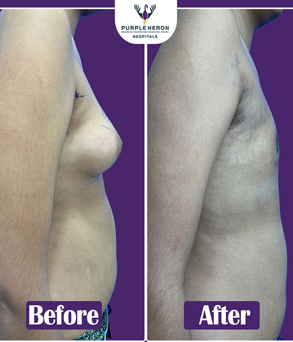 Gynecomastia Surgery Expertise