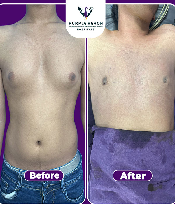 Gynecomastia Surgery Expertise