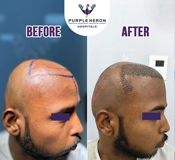 Plastic Surgery Patient of Dr. Lamoria