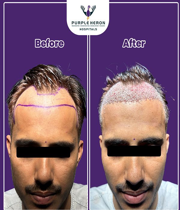 Hair Transplant Surgery Expertise