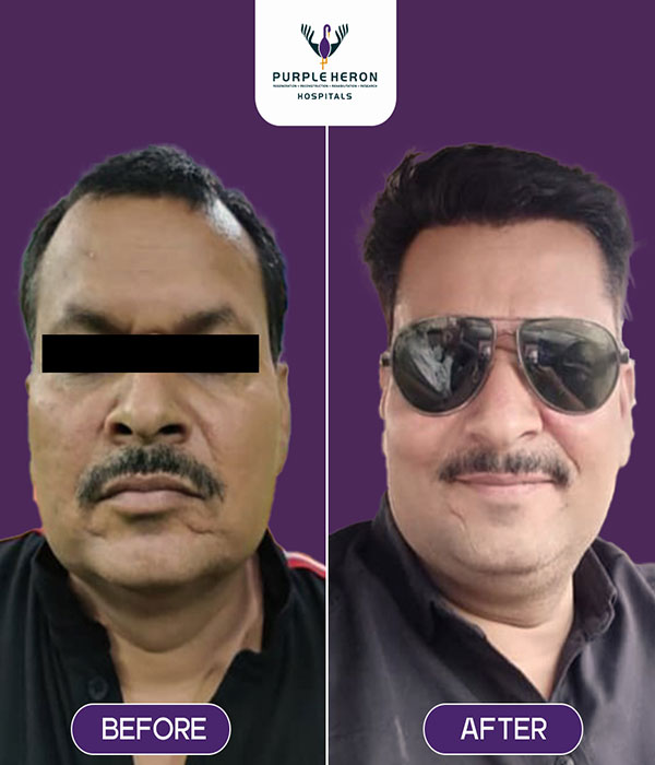 Hair Transplant Surgery Expertise