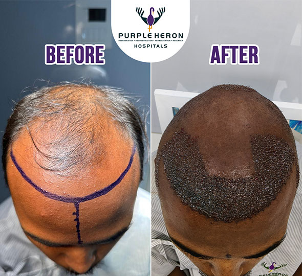 Plastic Surgery Patient of Dr. Lamoria