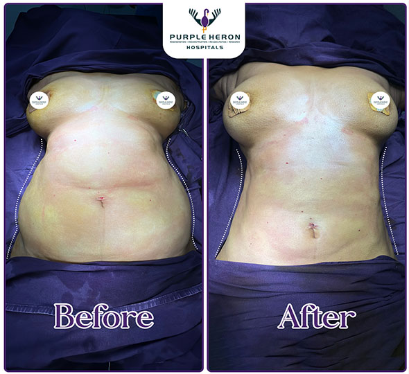 Plastic Surgery Patient of Dr. Nitesh Lamoria