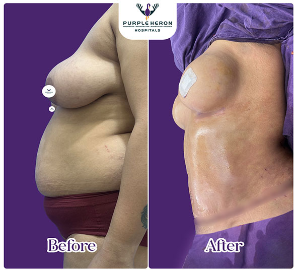 Plastic Surgery Patient of Dr. Nitesh Lamoria