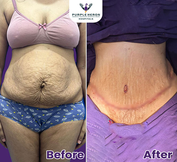 Plastic Surgery Patient of Dr. Nitesh Lamoria