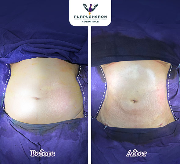 Plastic Surgery Patient of Dr. Nitesh Lamoria