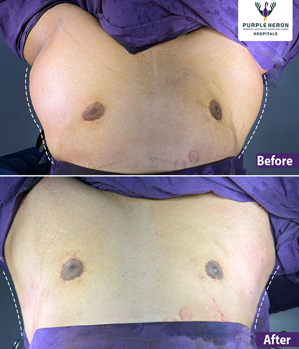 Dr. Nitesh Lamoria Hair Transplant