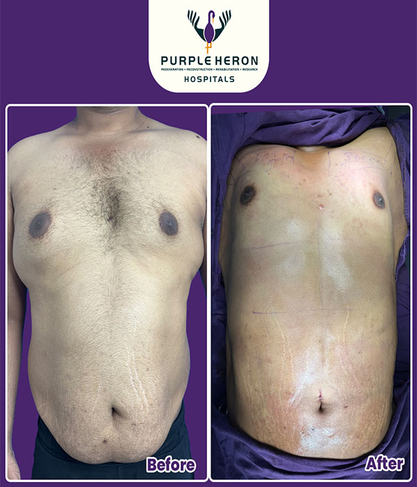 Hair Transplant Surgery Expertise