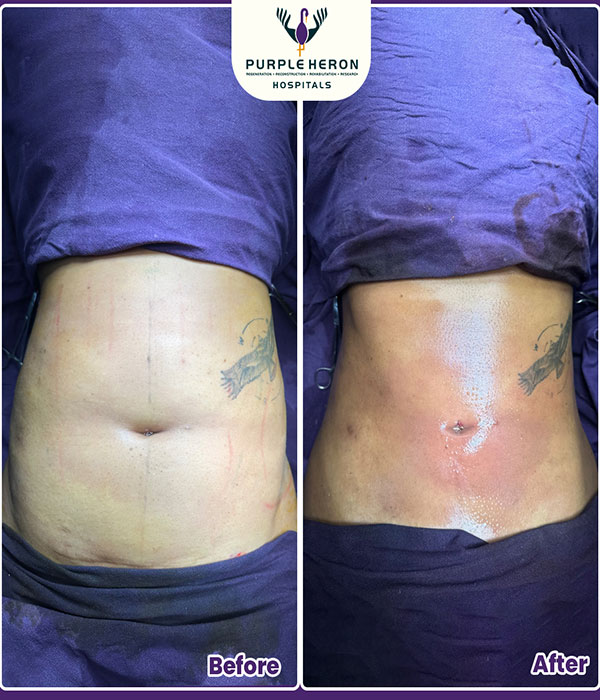 Hair Transplant Surgery Expertise