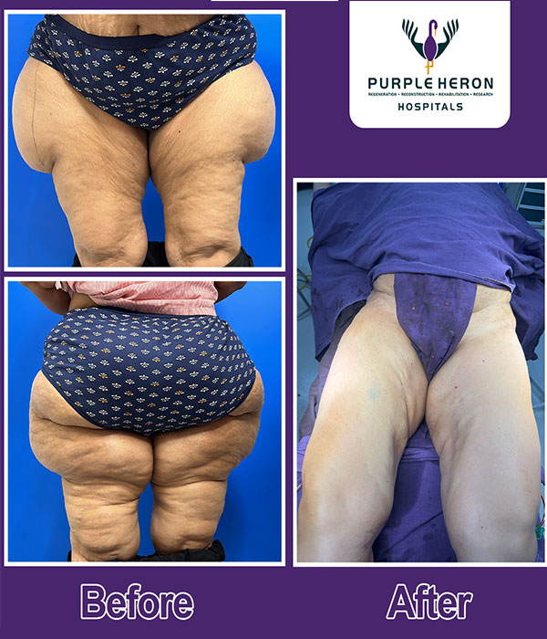 Hair Transplant Surgery Expertise