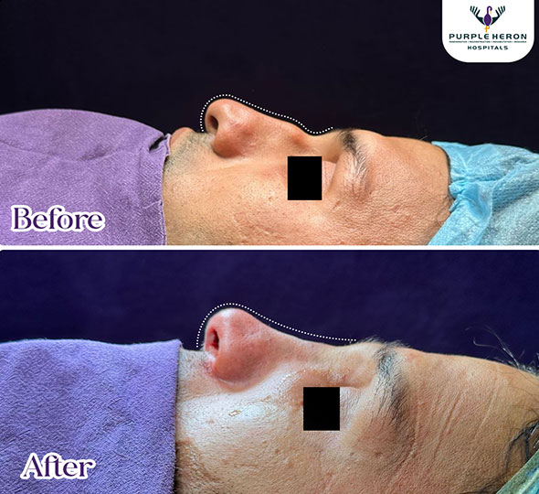 Plastic Surgery Patient of Dr. Lamoria