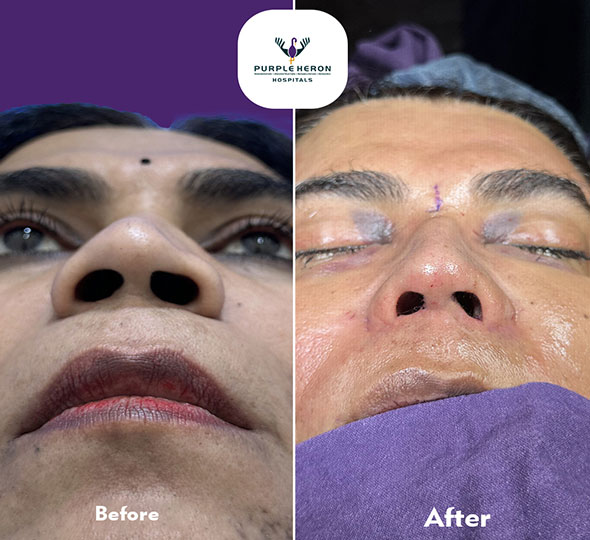 Plastic Surgery Patient of Dr. Lamoria