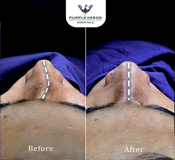 Plastic Surgery Patient of Dr. Lamoria