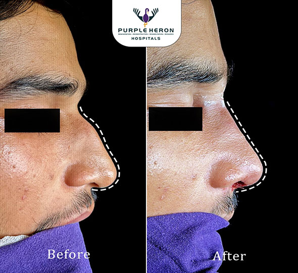 Plastic Surgery Patient of Dr. Lamoria