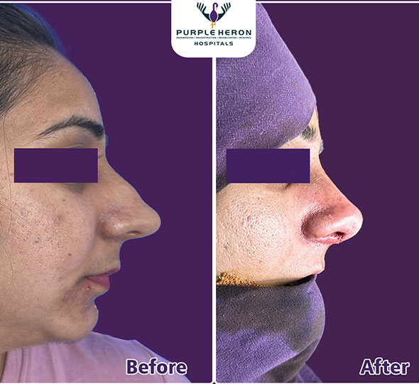 Plastic Surgery Patient of Dr. Lamoria