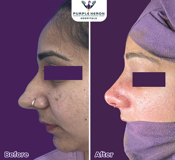 Plastic Surgery Patient of Dr. Lamoria