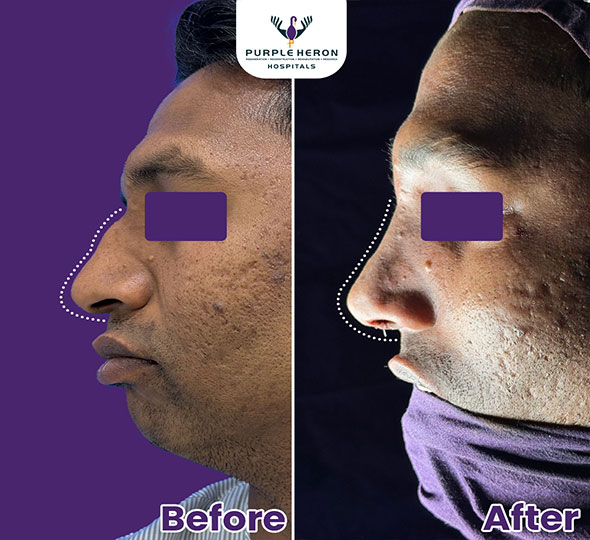 Plastic Surgery Patient of Dr. Lamoria