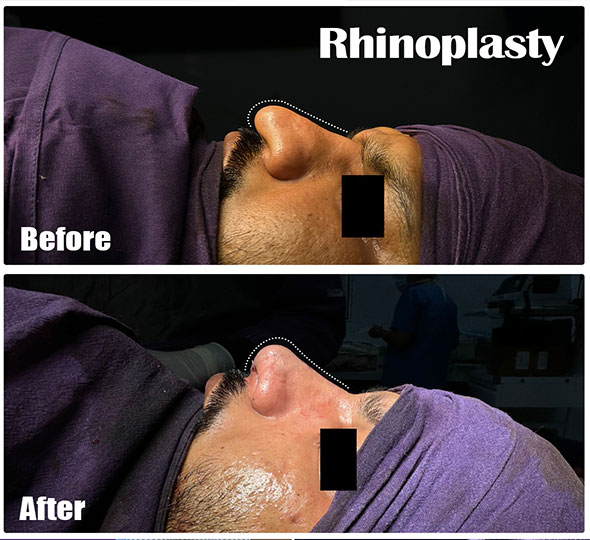 Plastic Surgery Patient of Dr. Lamoria