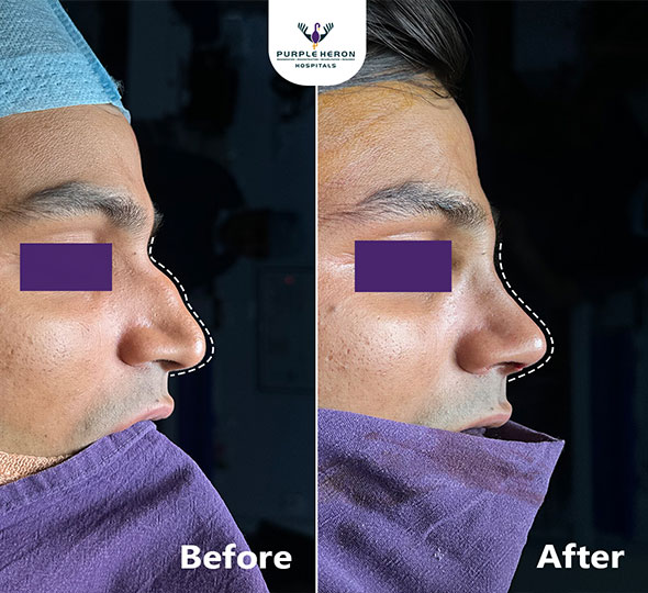 Plastic Surgery Patient of Dr. Lamoria