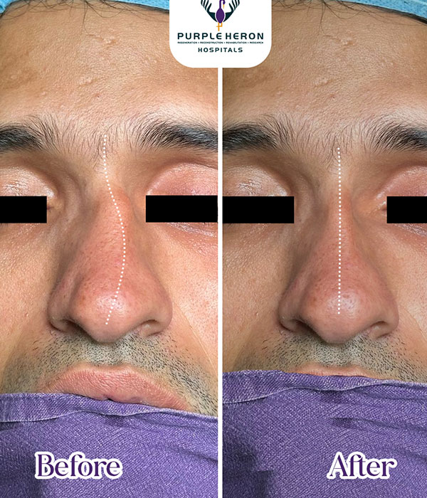 Dr. Nitesh Lamoria Rhinoplasty