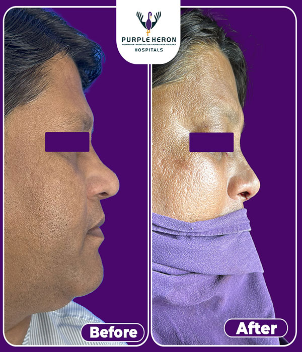 Rhinoplasty Surgery Expertise