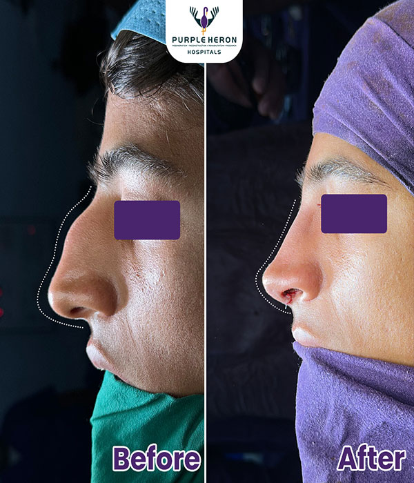 Rhinoplasty Surgery Expertise