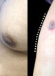 Gynecomastia Surgery in Jaipur