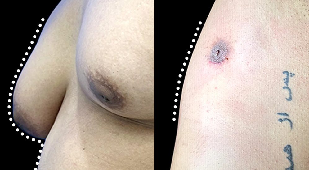 Gynecomastia Surgery in Jaipur Gynecomastia Surgery in Jaipur